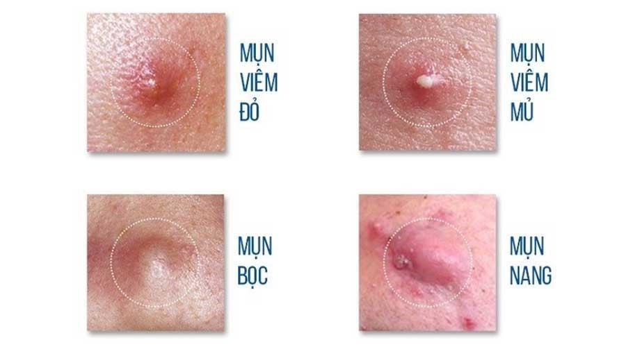 Mụn sưng viêm – Không chỉ là chuyện thẩm mỹ