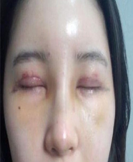 Phẫu thuật thẩm mỹ bị bầm tím thì phải làm sao?