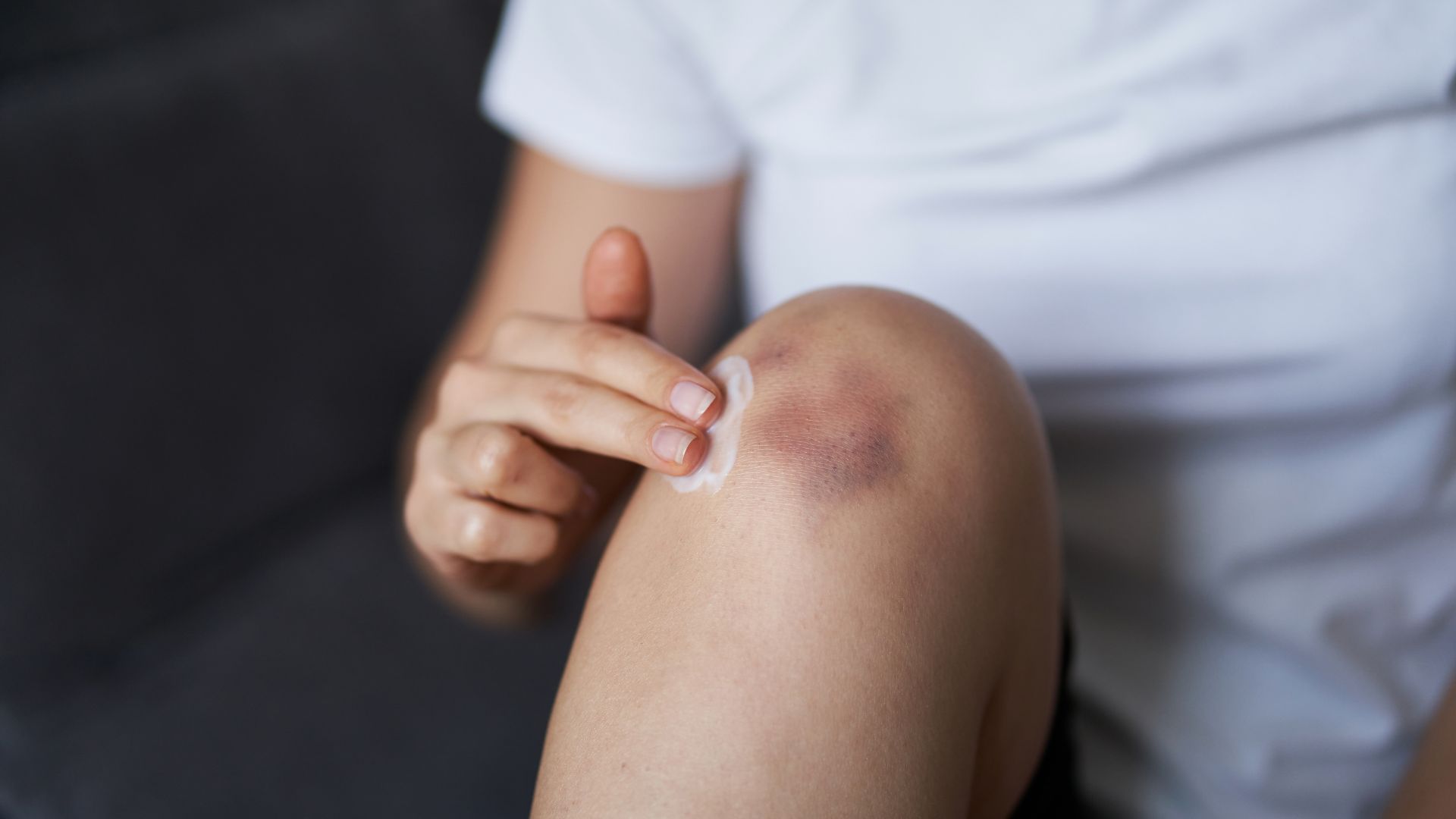 Chân bị bầm tím phải làm sao, hướng dẫn cách xử lý đúng