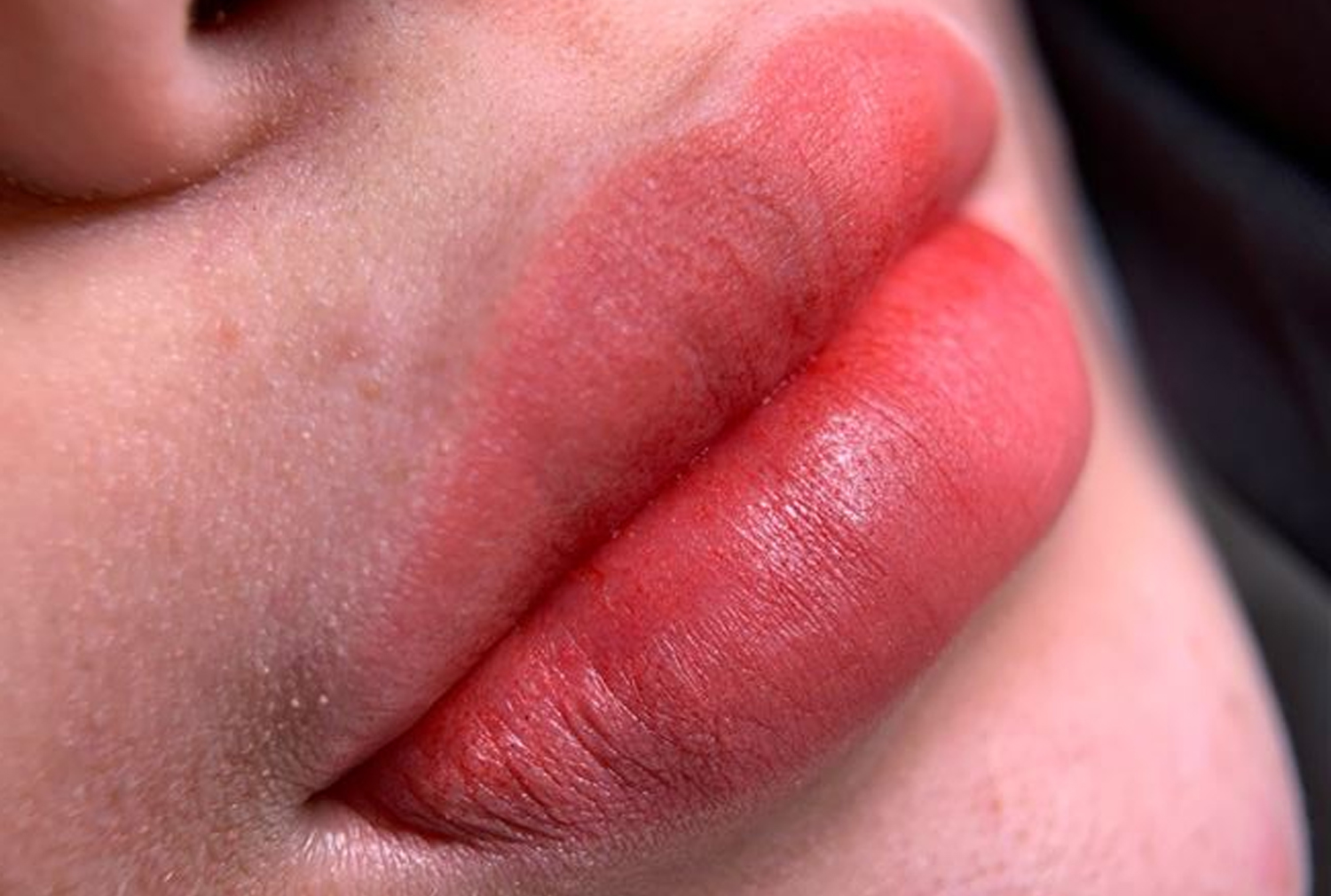 Phun xăm môi bị sưng tấy: Nguyên nhân và cách xử lý an toàn tại nhà