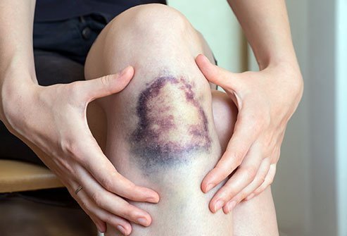 Tan máu bầm sau tai nạn - Nên dùng thuốc gì để giảm đau, tránh tụ huyết?