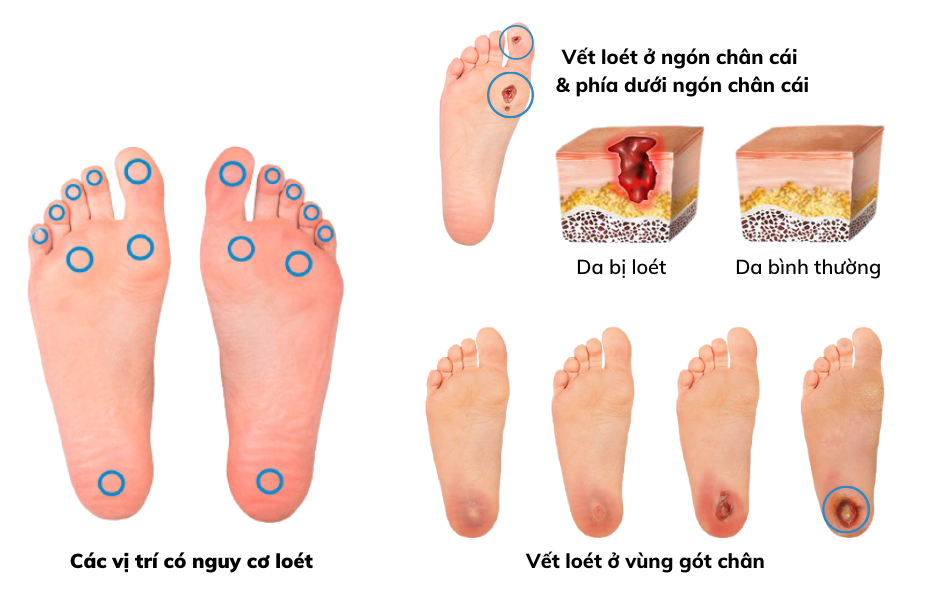 Người có bệnh lý nền (tiểu đường, cao huyết áp) bị vết thương: Cẩn trọng gì?